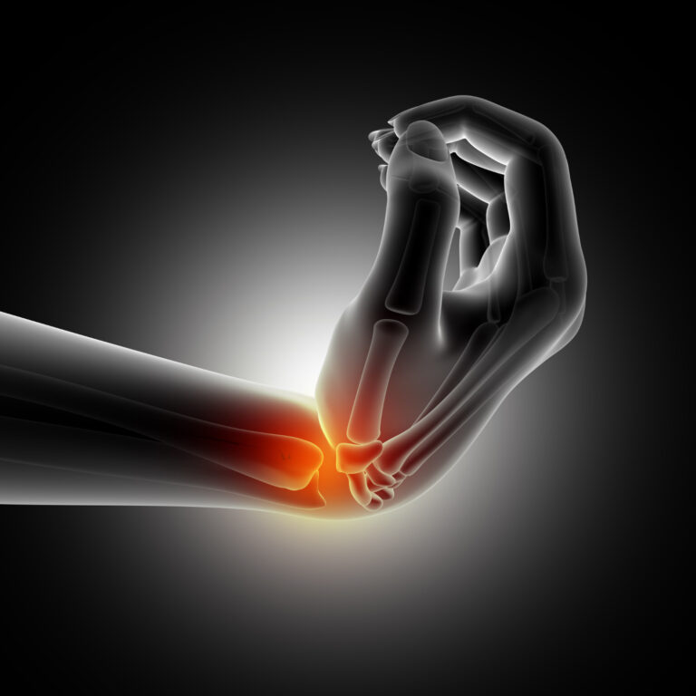 Read more about the article Navigating Carpal Tunnel Syndrome: Expert Tips from Dr. Amit Roy, Kolkata’s Leading Orthopedic Surgeon