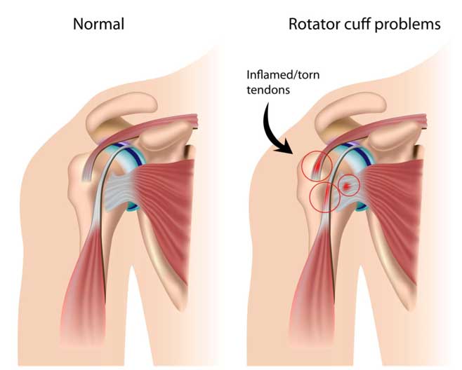 Read more about the article Rotator Cuff Repair Surgery: Contact Dr. Amit Roy, Best Orthopedic Surgeon in Kolkata