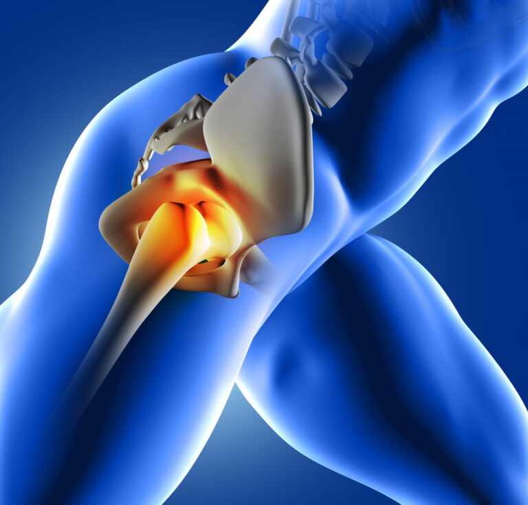 Read more about the article Navigating Hip Replacement: Expert Tips from Dr. Amit Roy, Kolkata’s Leading Orthopedic Surgeon