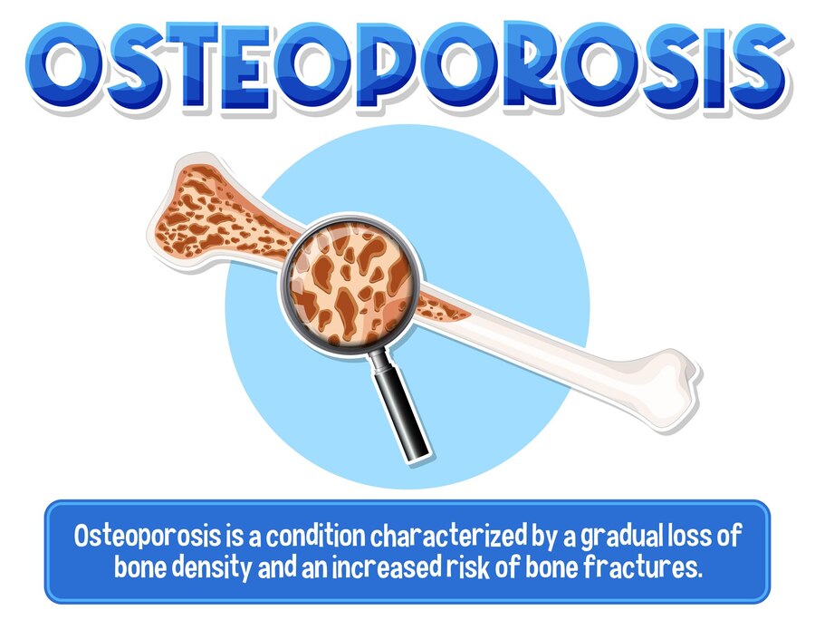 Read more about the article Understanding Osteoporosis: Prevention and Treatment Strategies